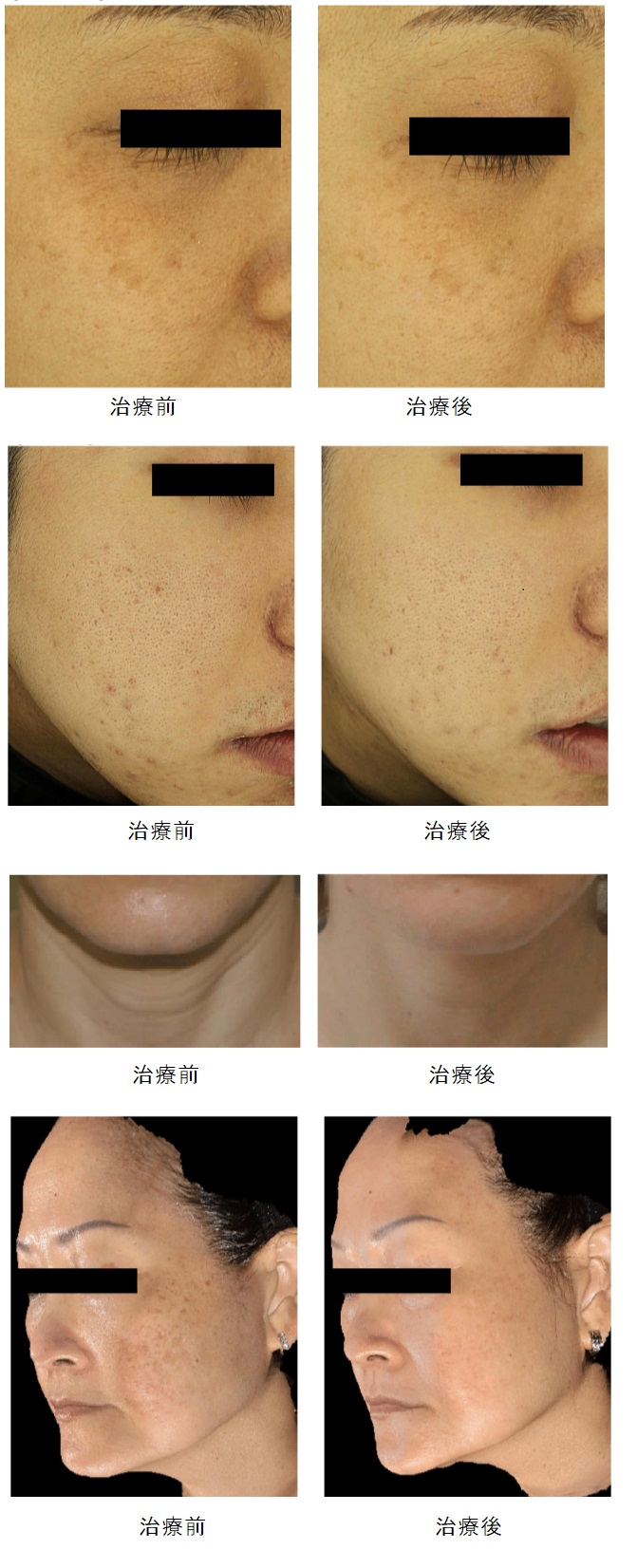 しみ／そばかす／肝斑治療｜東京八丁堀皮膚科・形成外科【公式】｜美容