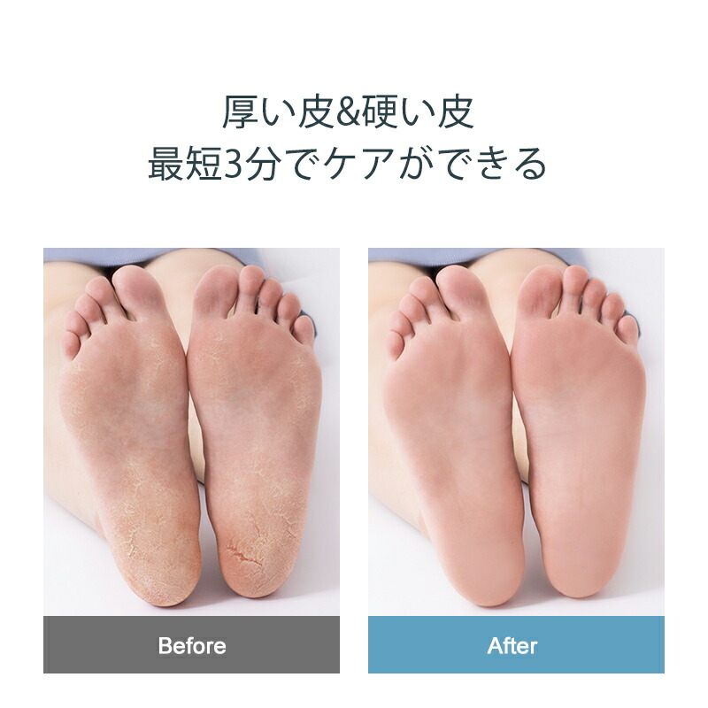 楽天市場】角質ケア 8点セット DG-FT8h1 （送料無料）フットケア