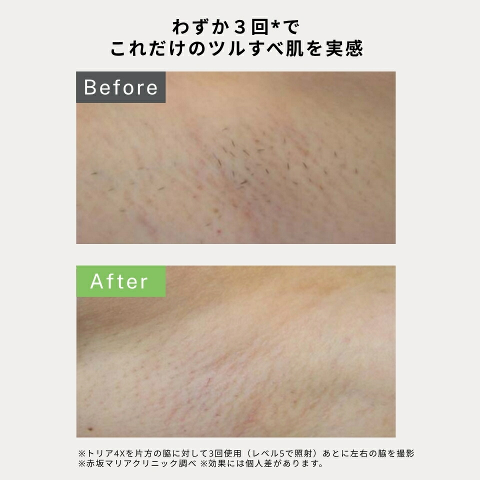 楽天市場】脱毛器 レーザー脱毛器 トリア 4X メンズ レディース 家庭用