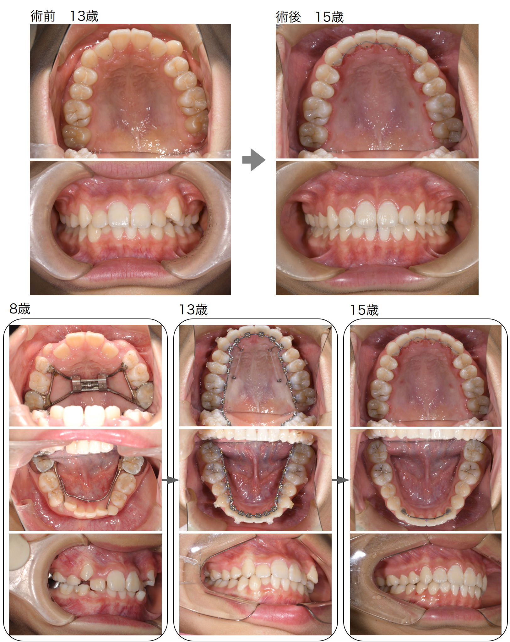 機能的矯正装置による顎顔面整形治療 機能的矯正装置による 顎顏面