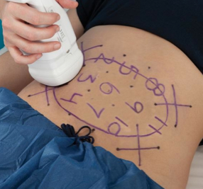 ライポソニックス（Liposonix）| ボディ・医療痩身｜北九州の美容外科