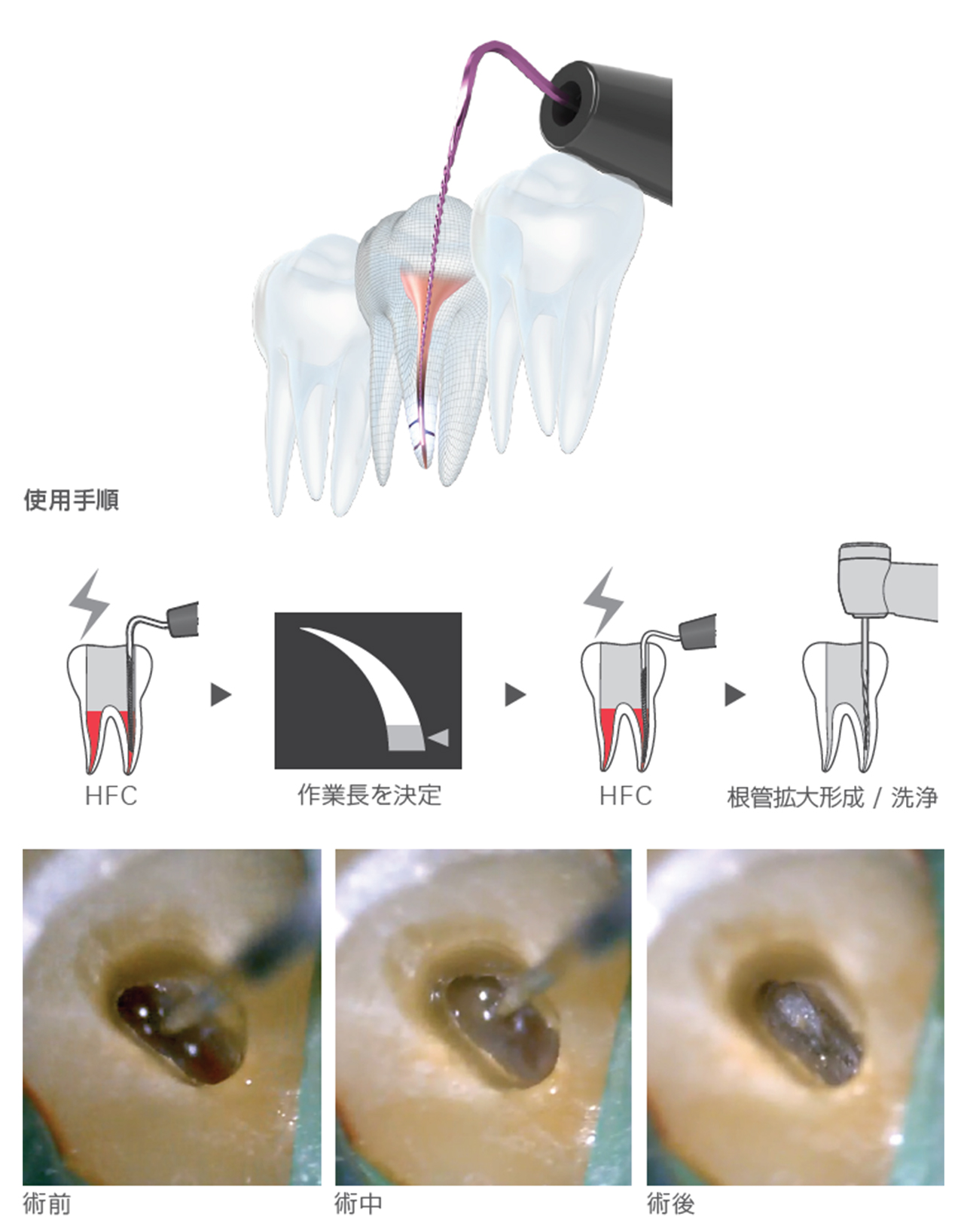 Root ZX3｜ササキ株式会社