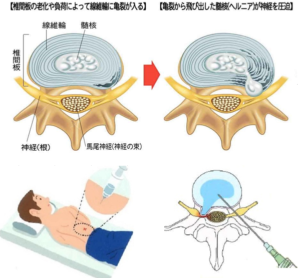 独立行政法人労働者健康安全機構 秋田労災病院｜お知らせ｜腰椎椎間板