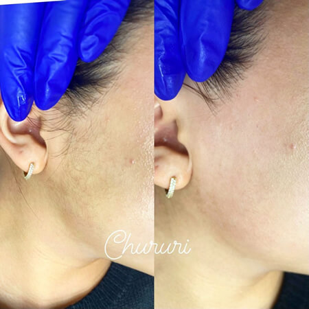 シュガーリング脱毛とは？｜【公式】ANNE Official Website | ネイル