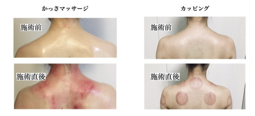 カッサ&カッピング効果 - Valerian