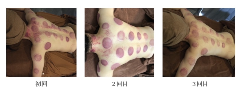 カッサ&カッピング効果 - Valerian