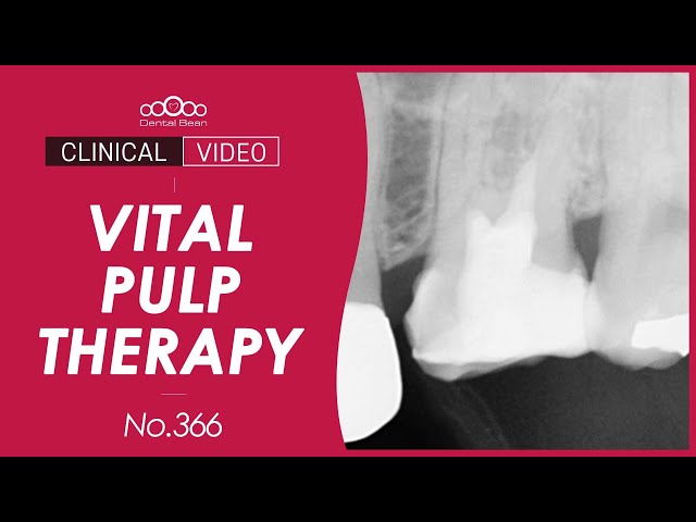 ENG_SUB] #26 Vital Pulp Therapy (VPT) [Dr. Park Charyum] - YouTube
