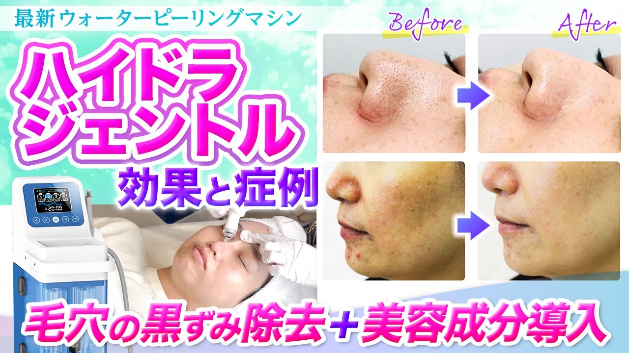 ハイドラフェイシャル（ハイドラジェントル）埼玉県のシュシュ