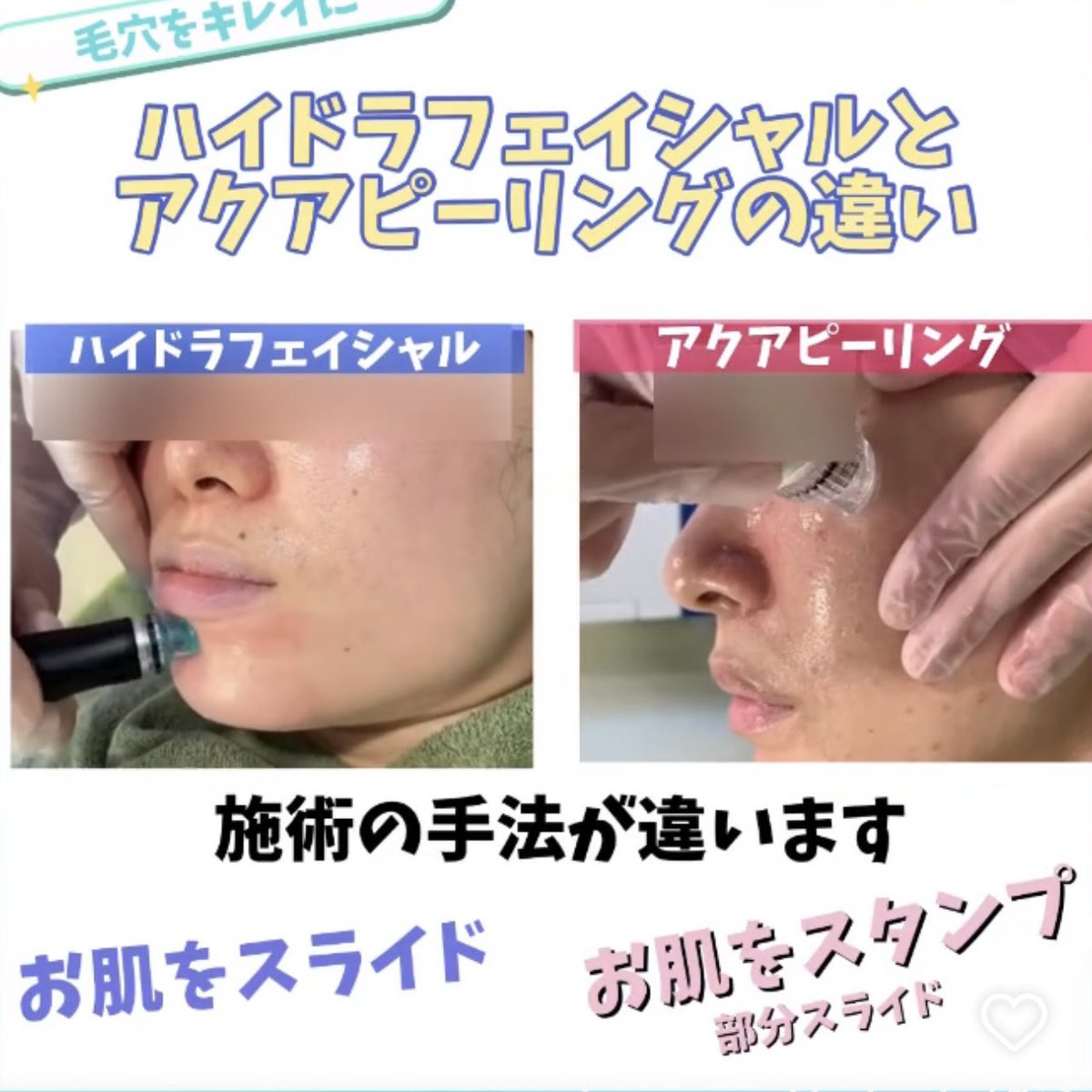 ハイドラフェイシャルとアクアピーリングの違いが分かりやすいの見つけ
