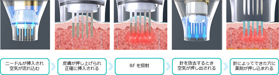 ニードルRF治療 ポテンツァ｜習志野市 津田沼の奏の杜すずらん皮膚科